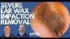 Severe Ear Wax Impaction Removal Ep918